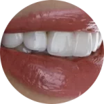 FACETAS DENTÁRIAS FACETAS DENTÁRIAS