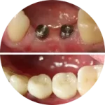 IMPLANTES E PROTOCOLOS IMPLANTES E PROTOCOLOS