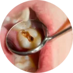 RESTAURAÇÃO DE DENTES COM CÁRIES RESTAURAÇÃO DE DENTES COM CÁRIES